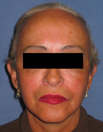 Facelift