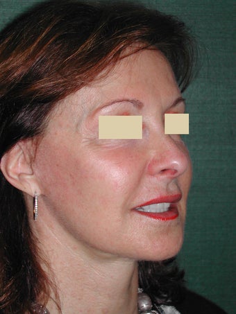 Female Facelift