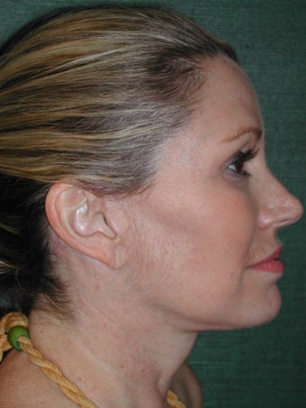 Female Facelift