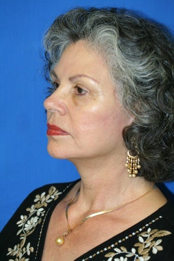 Facelift 