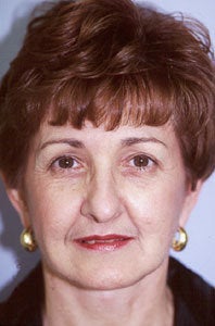 Lower SMAS facelift