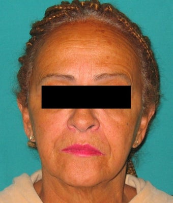 Facelift