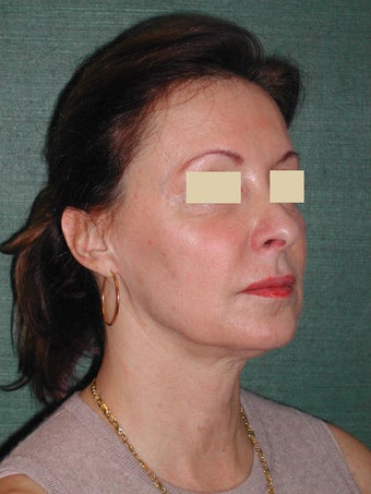 Female Facelift
