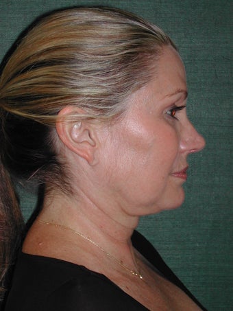 Female Facelift