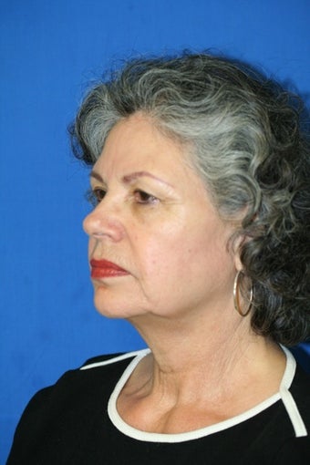 Facelift 