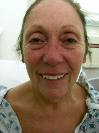 Facelift