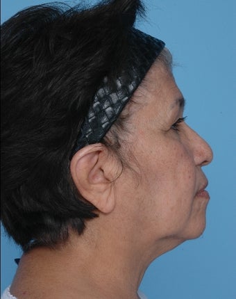 Upper Blepharoplasty and SMAS Facelift