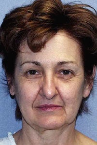 Lower SMAS facelift