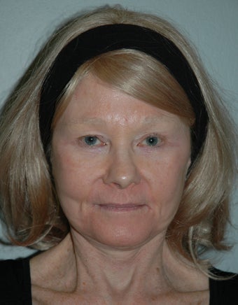 High SMAS Face Lift, Neck Lift, Perioral Dermabrasion