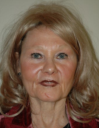 High SMAS Face Lift, Neck Lift, Perioral Dermabrasion