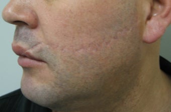 Scar Revision