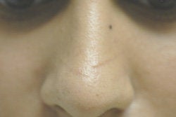 Scar Removal 