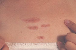 Keloid Scar Removal Los Angeles