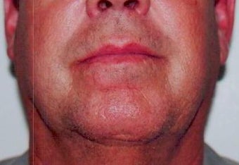 Scar Revision