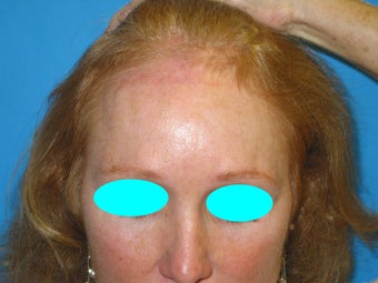 53 Year Old Female previoulsy treated with skin graft after skin cancer removal