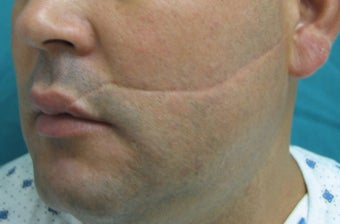 Scar Revision
