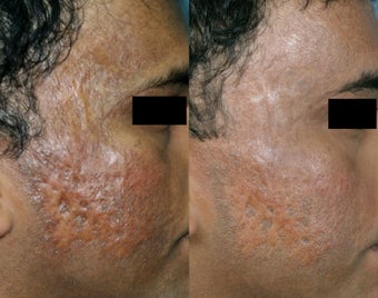 Fraxel Restore treatment of Facial Scars