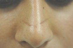 Scar Removal 