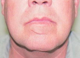 Scar Revision