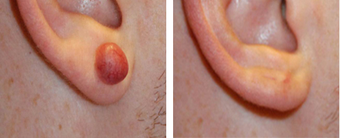 Scar Revision - Keloid Removal