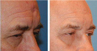 Scar Revision
