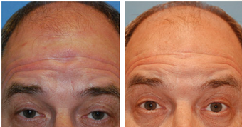 Scar Revision