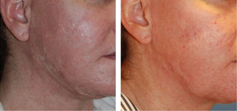 Scar Revision