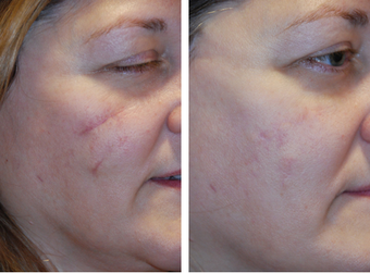 Scar Revision