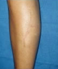 Scar revision of leg
