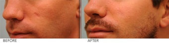 Scar Revision