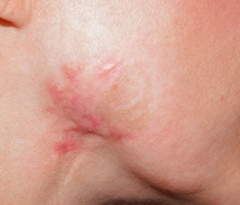 Vbeam for scar on jawline 