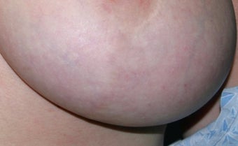 Breast implant scar removal