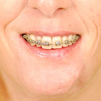 Scar Revision - Lower Lip