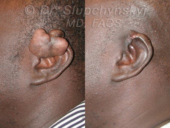 Keloid Removal