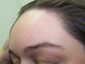 Scar Removal by Fat Transfer