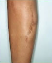 Scar revision of leg