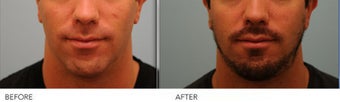 Scar Revision