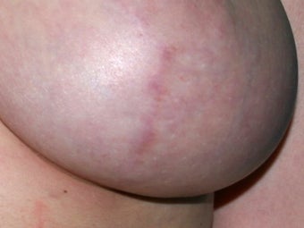 Breast implant scar removal