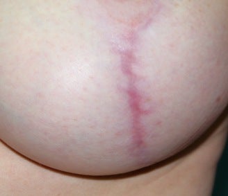 Laser for breast implant scar