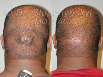 Keloid Removal