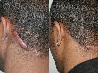Keloid Removal