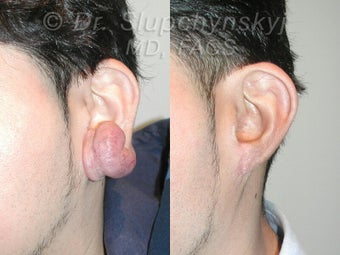 Keloid Removal