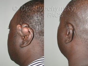 Keloid Removal