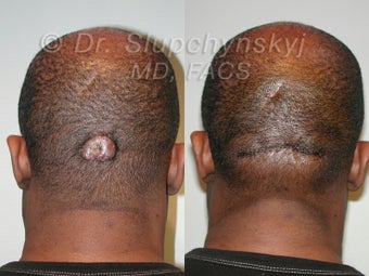 Keloid Removal