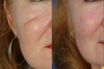 Scar Revision Surgery