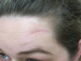 Scar Removal by Fat Transfer
