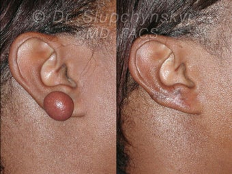 Keloid Removal