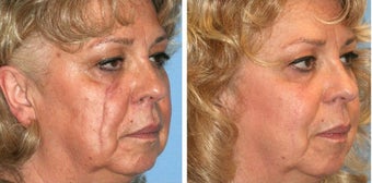 Scar Revision