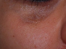Scar Treatment