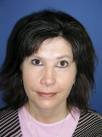 Facial Scar Improvement